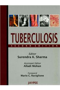 Tuberculosis