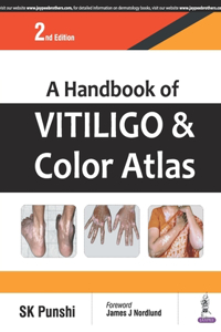 A Handbook of Vitiligo and Color Atlas