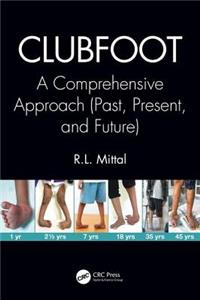 Clubfoot