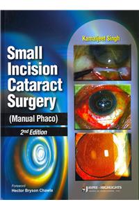 Small Incision Cataract Surgery (Manual Phaco)