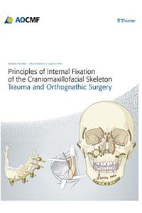 Principles of Internal Fixation of the Craniomaxillofacial Skeleton