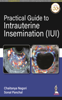 Practical Guide to Intrauterine Insemination (IUI)